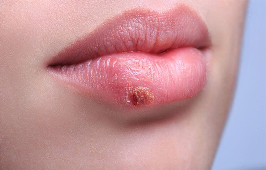 11 Cold Sore Remedies to Remove Them Naturally!