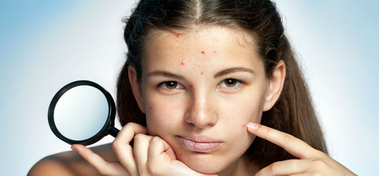 HOME REMEDIES FOR BLACKHEADS