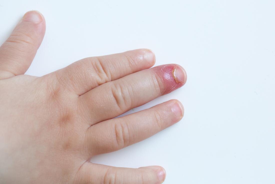 WHAT IS NAIL PARONYCHIA – WAYS TO FIGHT THE CONDITION?