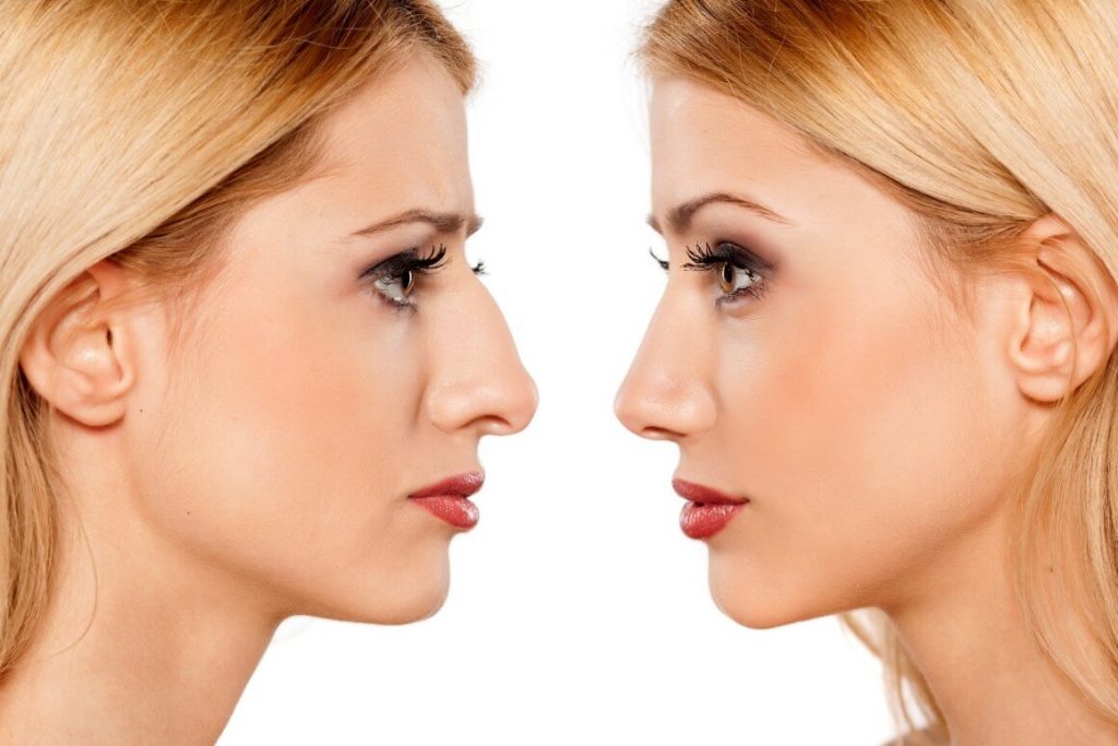 Is Non-Surgical Rhinoplasty Worth it?