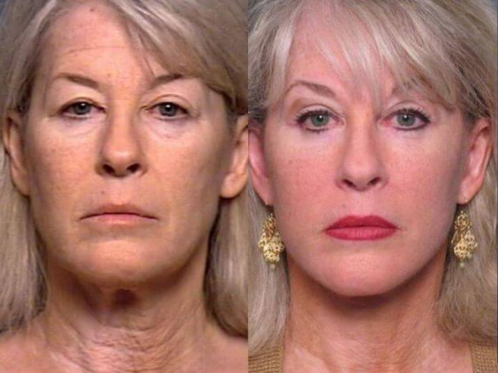 Facelifts: What To Expect During Recovery 